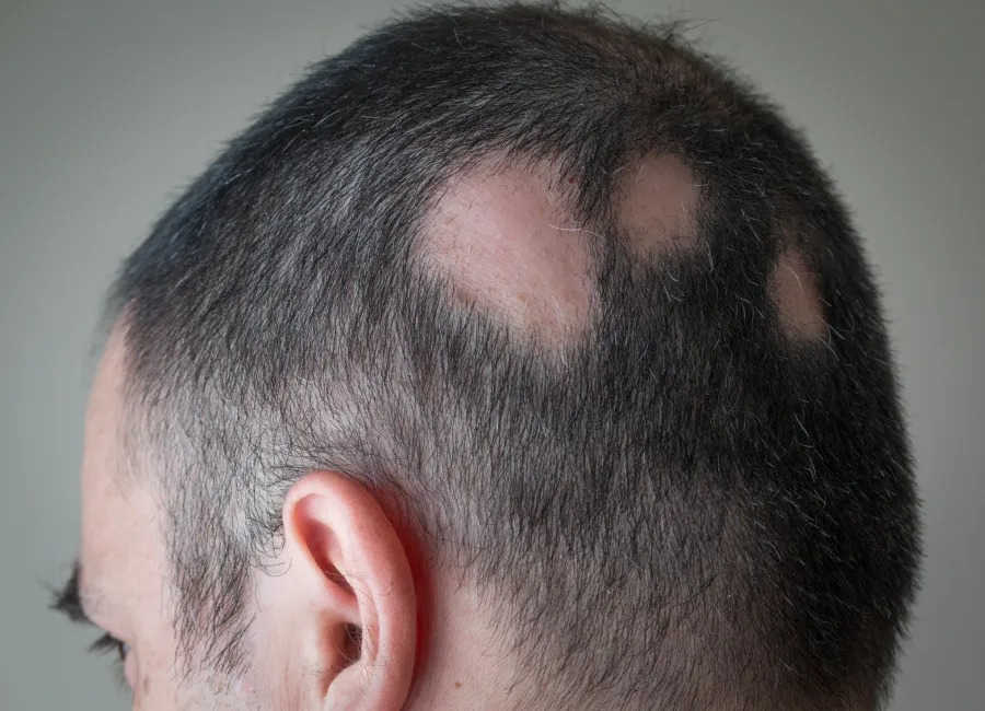 Alopecia Restoration Through Scalp Massage Therapy Cleveland Heights, OH Alopecia Restoration Through Scalp Massage Therapy Cleveland Heights, OH
