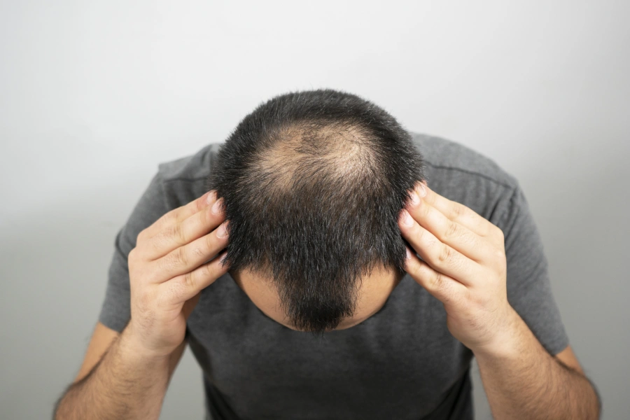 Alopecia Restoration Through Scalp Massage Therapy in Cleveland Heights, OH Alopecia Restoration Through Scalp Massage Therapy in Cleveland Heights, OH