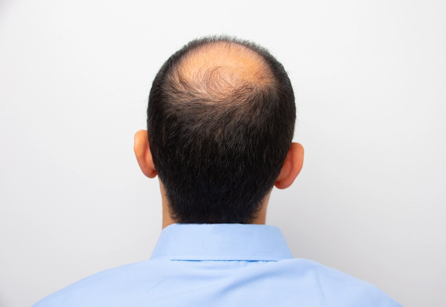 Understanding the Causes of Scalp Imbalance Cleveland Heights, OH Understanding the Causes of Scalp Imbalance Cleveland Heights, OH